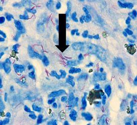 Mycobacterium-leprae