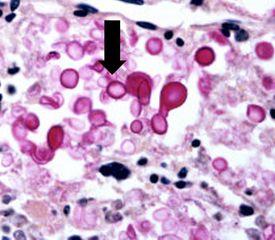 Cryptococcus-Neoformans