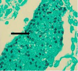 PNEUMOCYSTIS