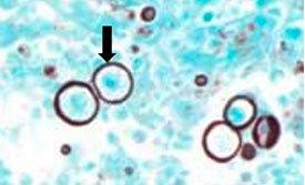 HISTOPLASMOSIS